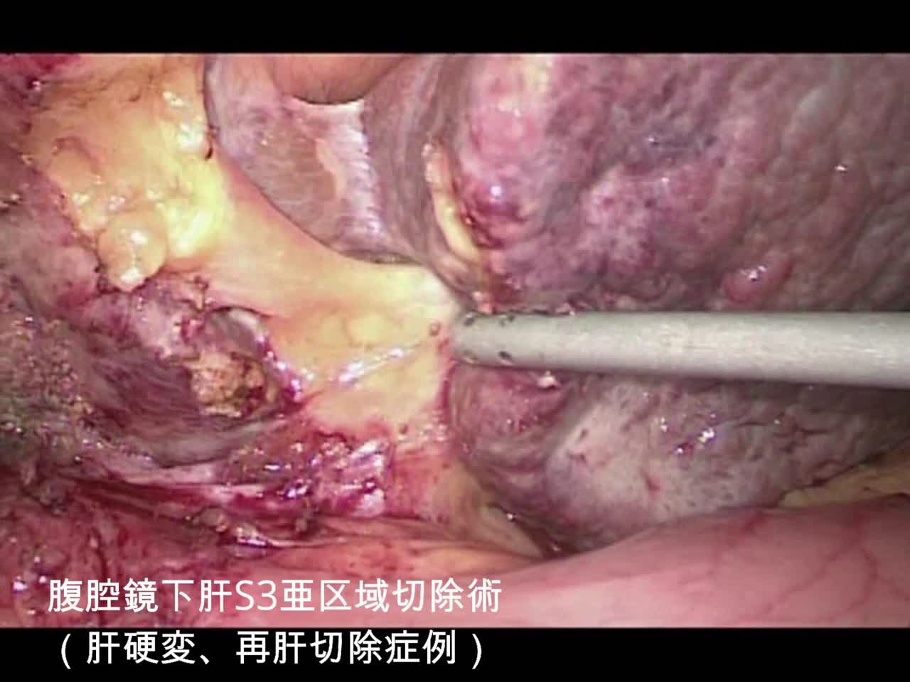 動画3 腹腔鏡下肝S3亜区域切除術