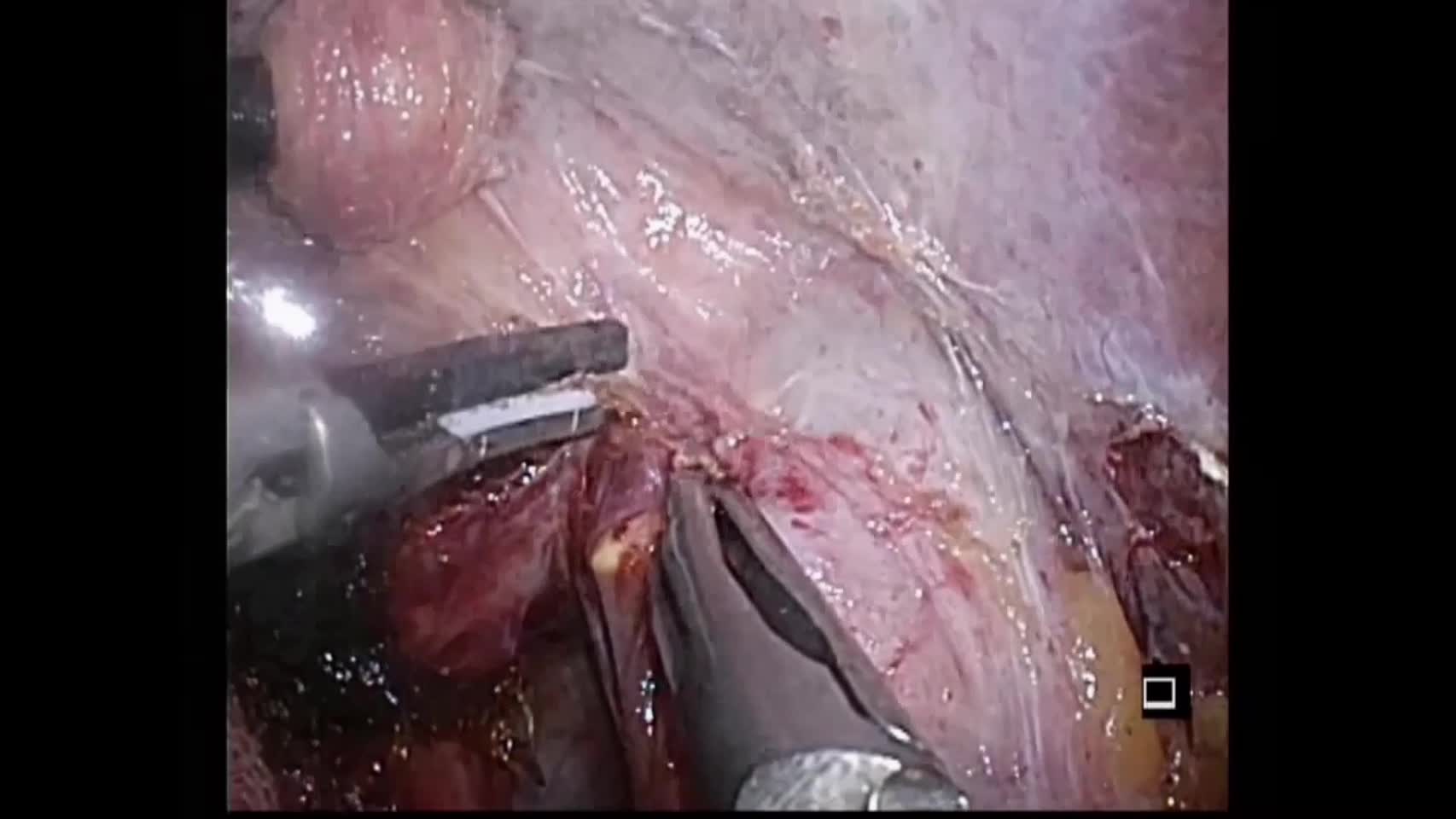 動画1 water jetメスを使った左半側臥位肝非脱転腹腔鏡下肝後域切除術...