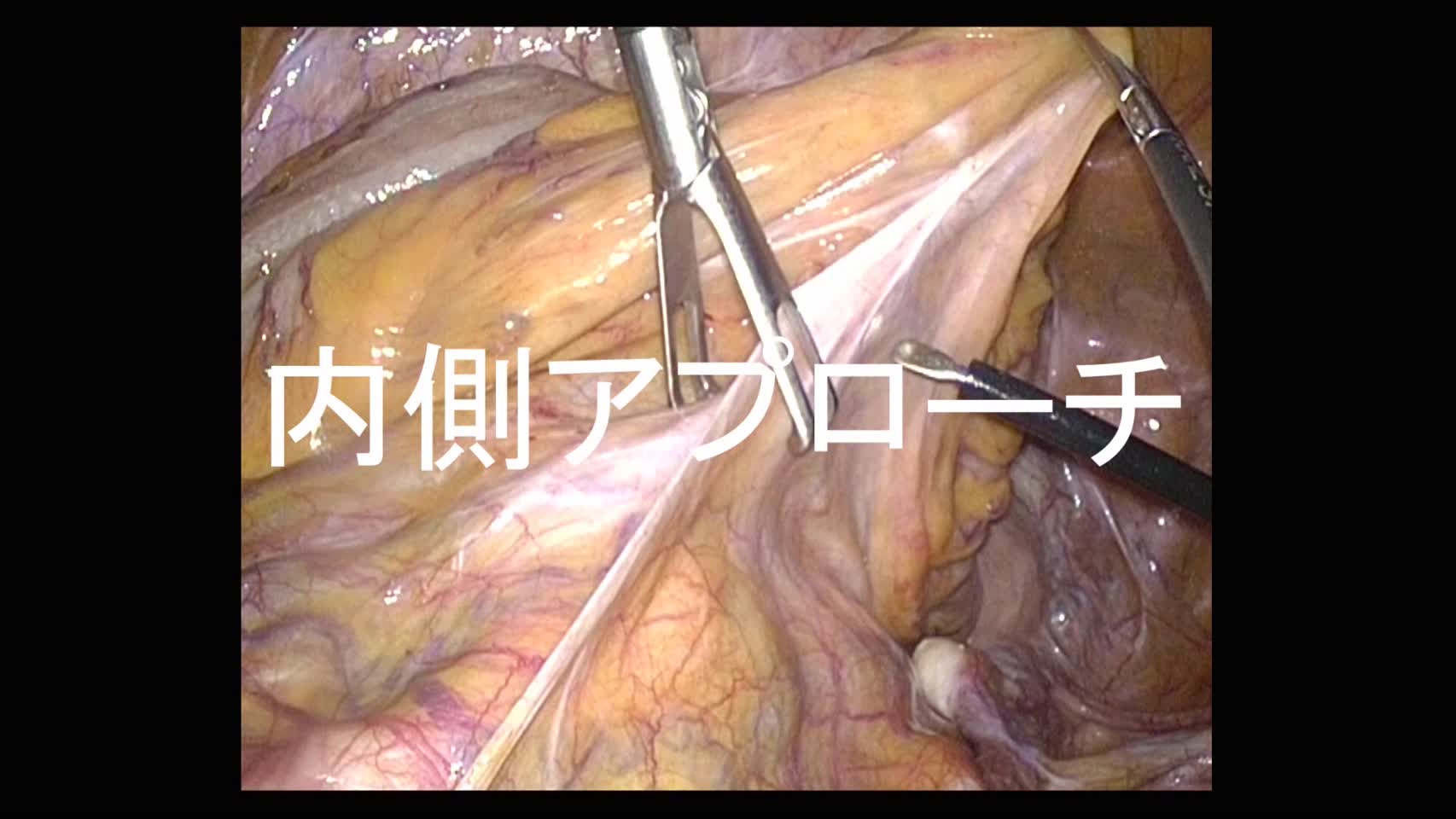 動画1 左側結腸ならびに直腸の悪性腫瘍に対する腹腔鏡下手術における術野の展開法...