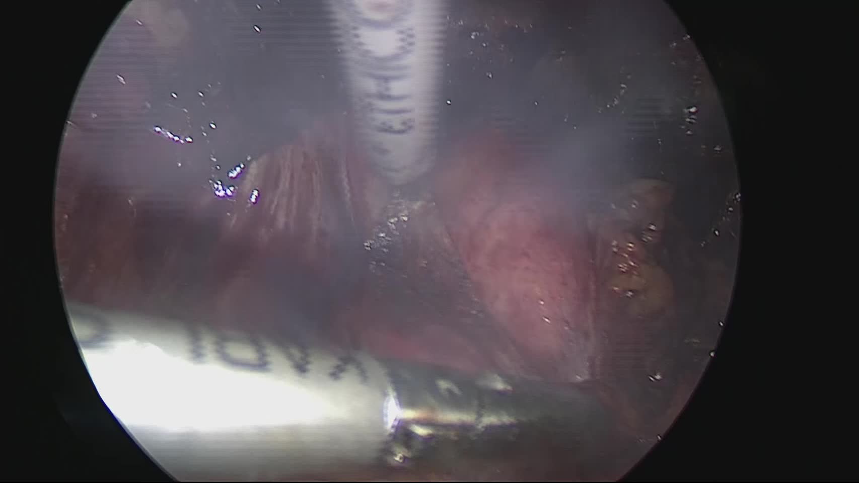 動画2 骨盤内内膜症病巣部位の切除