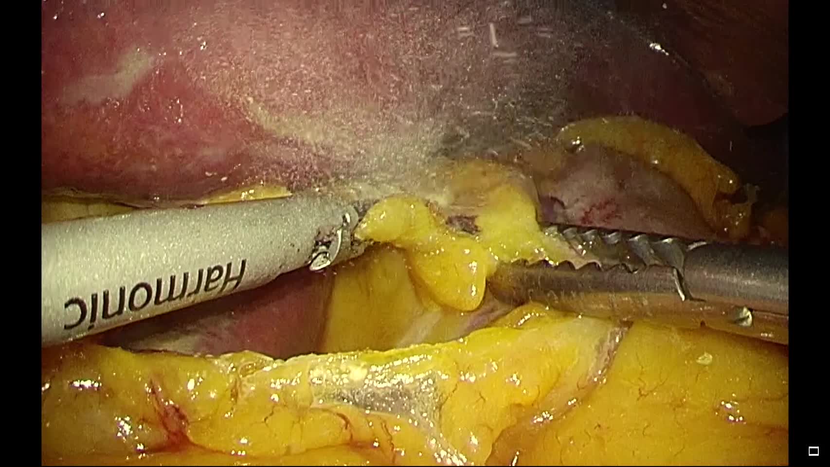 動画1 胃癌手術時の肝臓圧排法