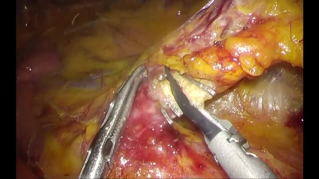 動画1 ハーモニック HD 1000iによる骨盤内臓全摘術...