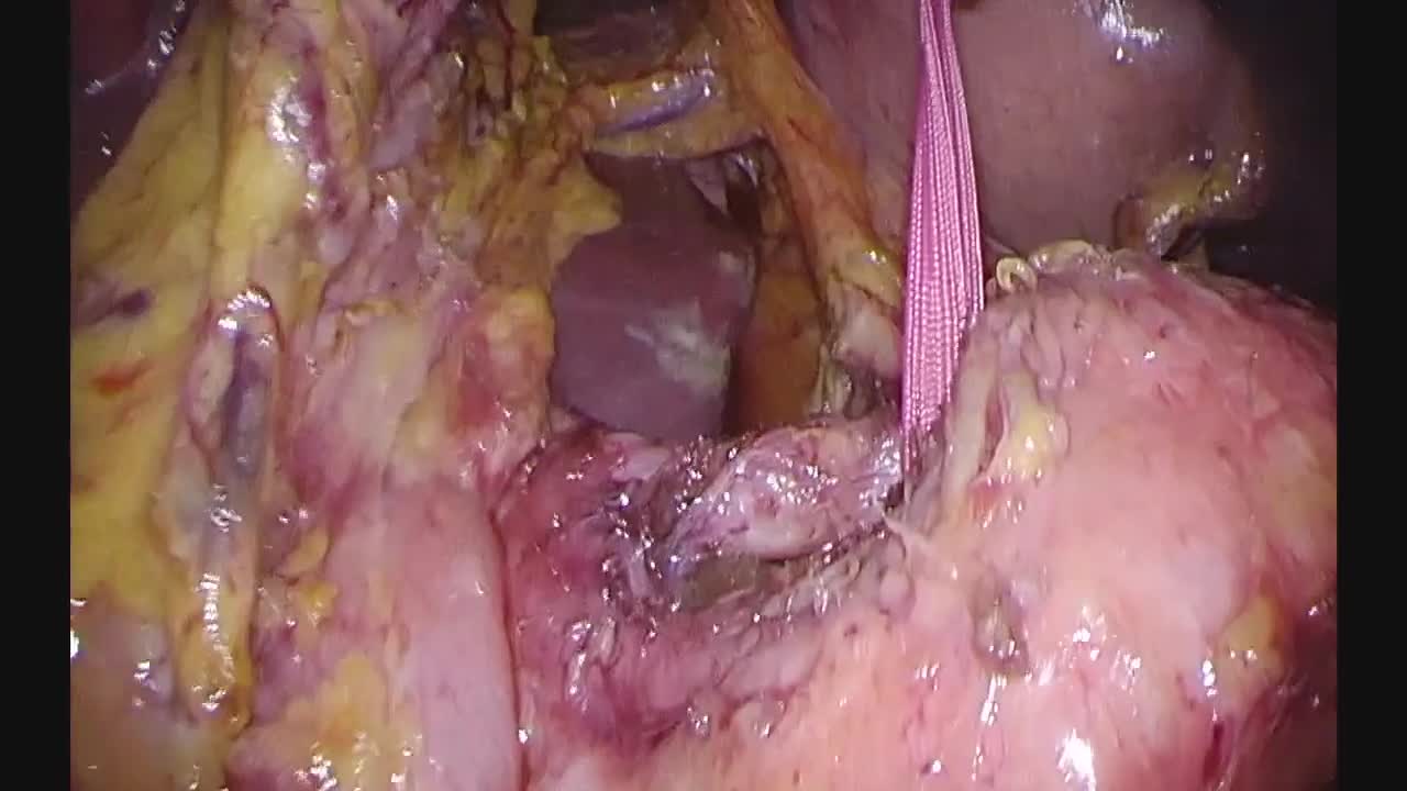 動画1 自動縫合器による膵切離