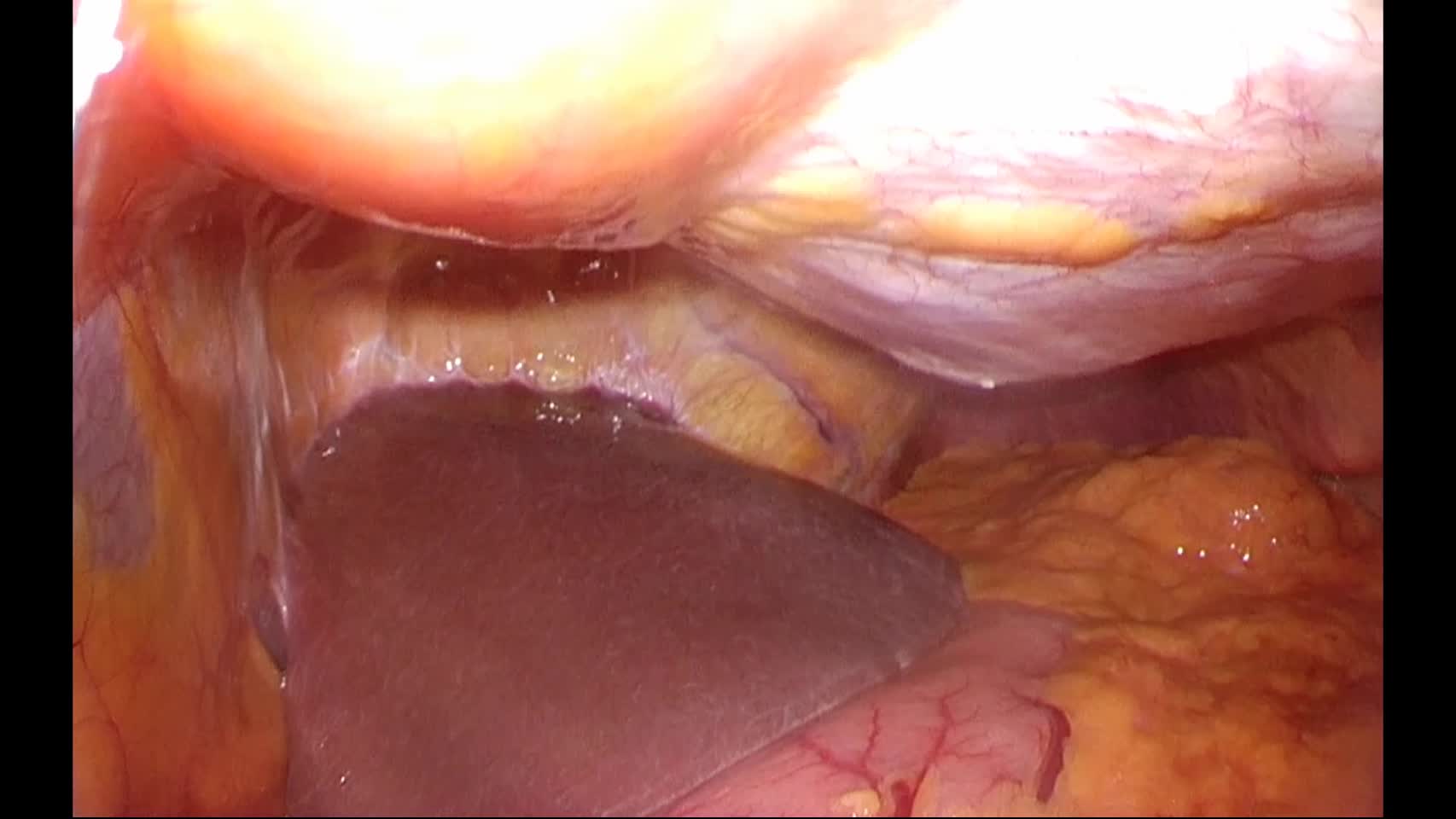 動画1 腹腔鏡下肝左葉切除のポート配置...