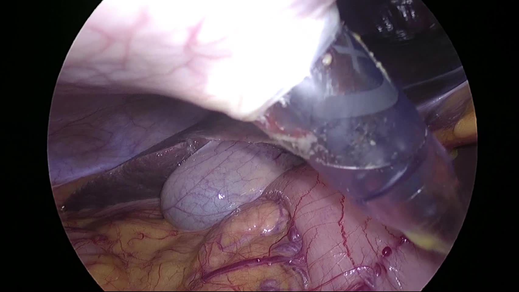 動画1 腹腔鏡下膵頭十二指腸切除術