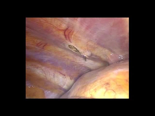 動画3 肺底部の肺部分切除
