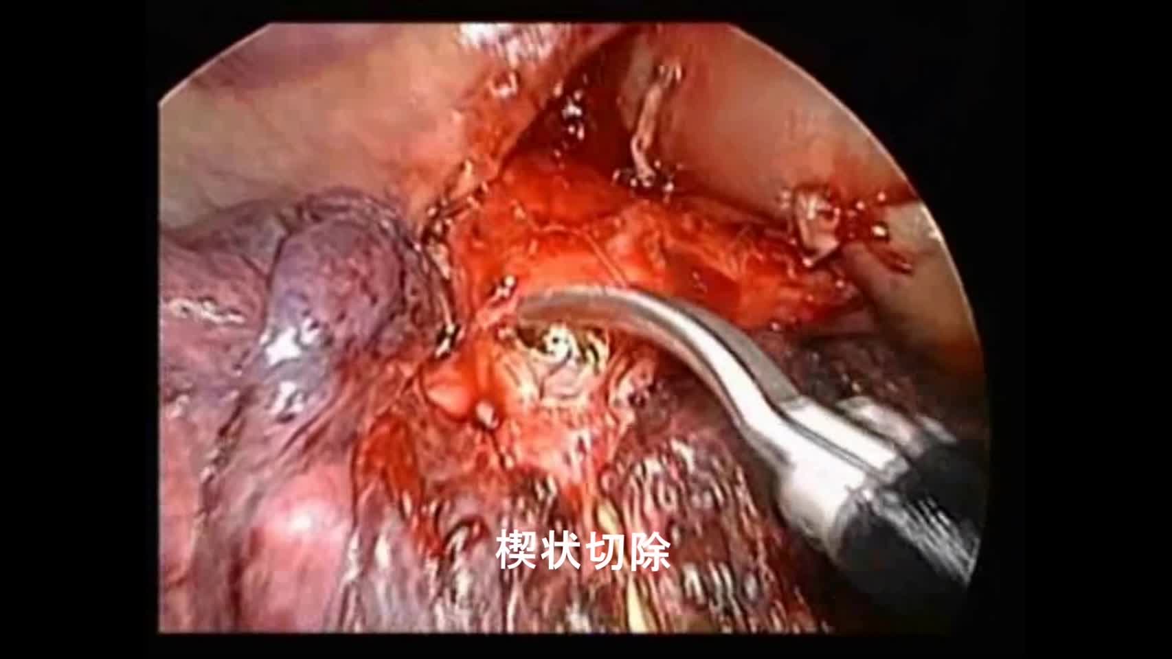 動画1 3ポート胸腔鏡下気管支形成術の手技...