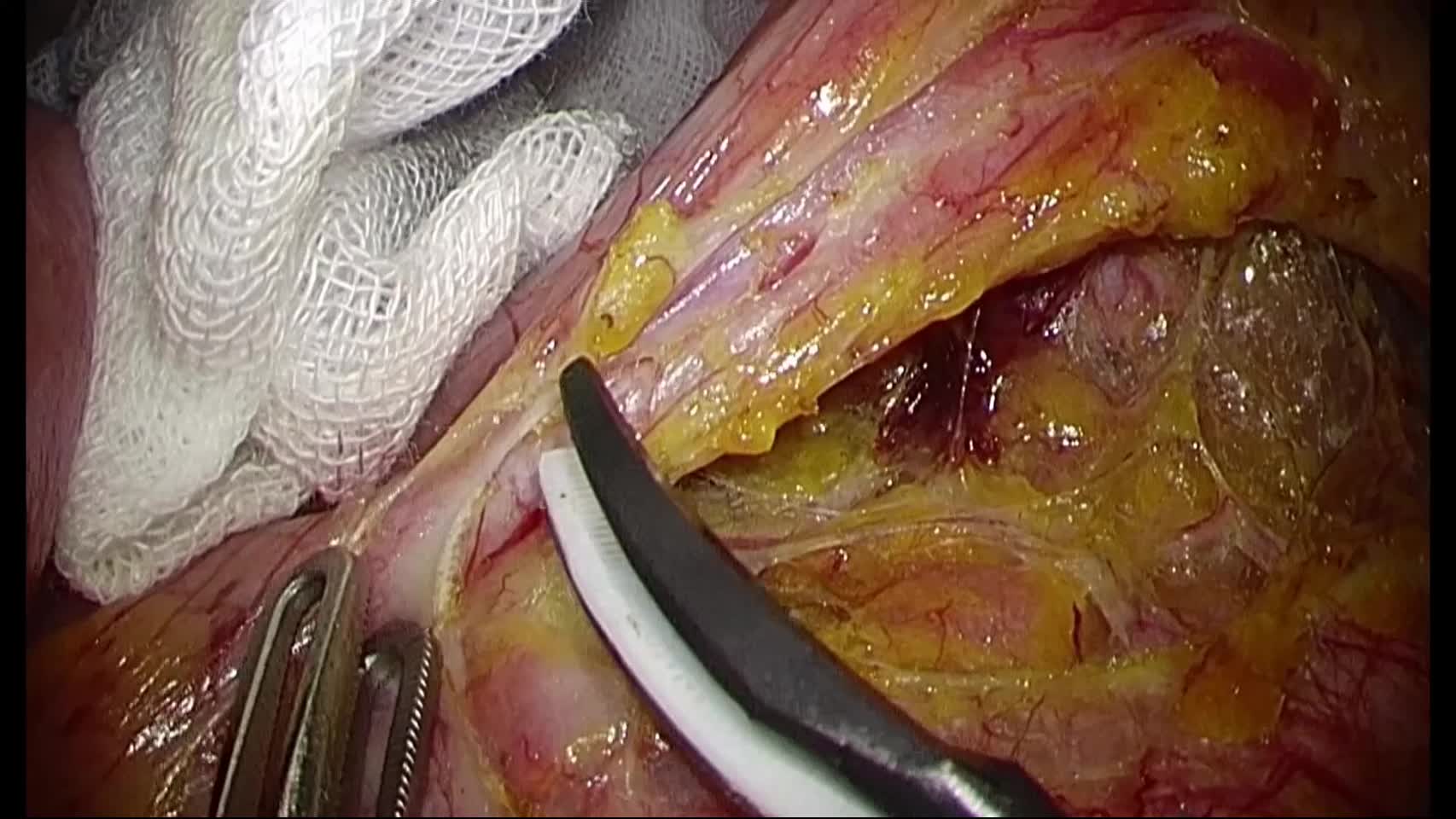 動画3 下腸間膜動脈周囲の郭清